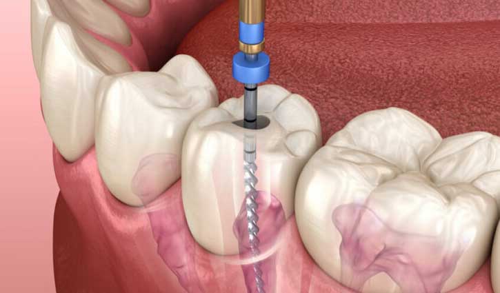 দাঁতে রুট ক্যানেল চিকিৎসা কখন নেবেন